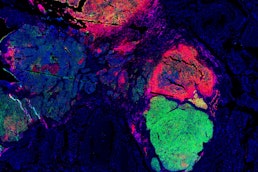 Multimodal Spatial Profiling Reveals Immune Suppression and Microenvironment Remodeling in Fallopian Tube Precursors to High-Grade Serous Ovarian Carcinoma