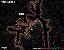 Spatial integration of protein and chromosomal states reveals early copy number changes and genotype-associated immune neighborhoods in serous ovarian cancer evolutio.